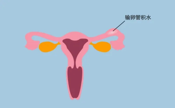 郑州不孕不育检查|输卵管为什么会积水?